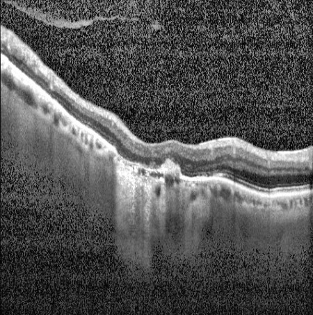Example retinal OCT B-scan